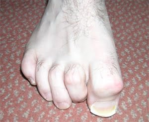 Deformed feet deals from high heels