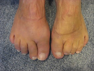 bunion-surgery