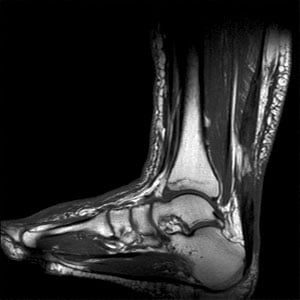 Achilles tendon rupture