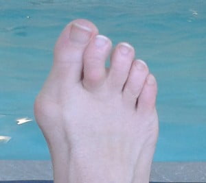 bunion surgery