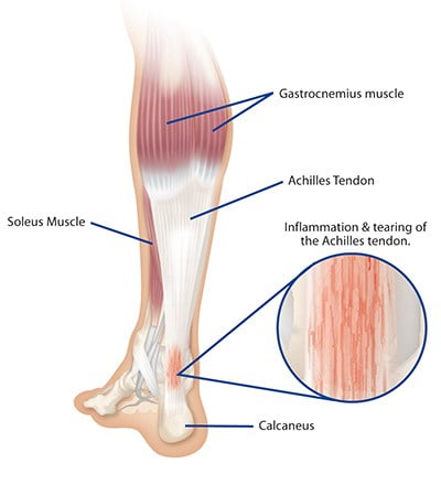 Achilles Tendon Rupture Important Questions To Consider