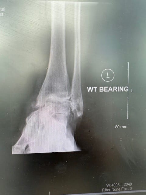 x-ray of ankle bone