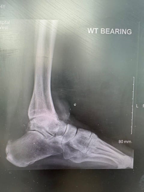 X-ray of ankle before recovery after ankle surgery